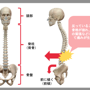 反り腰の姿勢から生まれる３つの問題