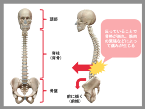 反り腰の姿勢から生まれる３つの問題