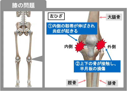 膝の痛みの問題