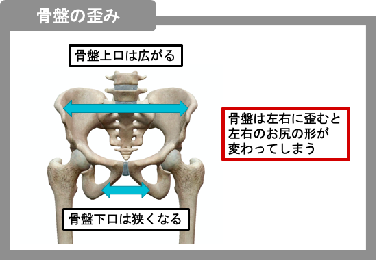 骨盤の歪みは左右でも起こります